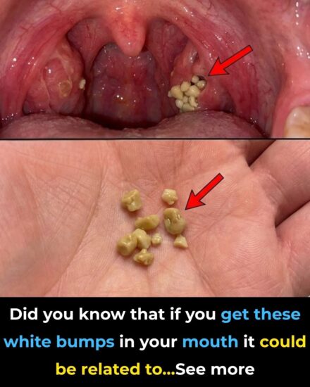 Tonsil Stones: Discover what they are, how they appear, and how to get rid of them forever.