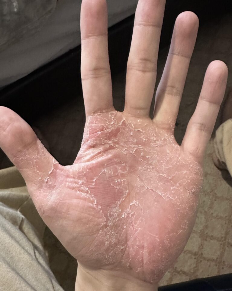 If This Appears on Your Hands, Be Careful: Why You Should Never Ignore These Warning Signs