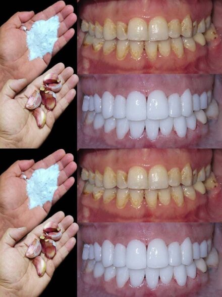 How to whiten your teeth in 2 minutes?